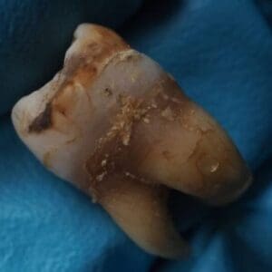 Suboxone Tooth Rot Lawsuit