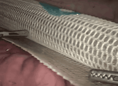 Implanting Symbotex Laparoscopically